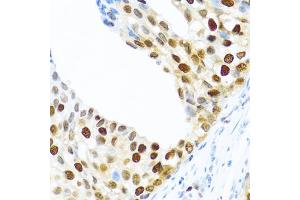 Immunohistochemistry of paraffin-embedded human prostate cancer using KHDRBS2 antibody. (KHDRBS2 antibody)