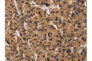 The image on the left is immunohistochemistry of paraffin-embedded Human liver cancer tissue using ABIN7190461(DEFA5 Antibody) at dilution 1/15, on the right is treated with synthetic peptide. (DEFA5 antibody)