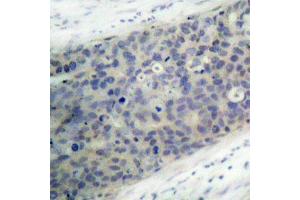 Immunohistochemistry of paraffin-embedded human breast carcinoma using Phospho-LIMK2-T505 antibody (ABIN2988124). (LIMK2 antibody  (pThr505))