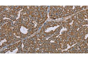 Immunohistochemistry of paraffin-embedded Human ovarian cancer using CERS4 Polyclonal Antibody at dilution of 1:35 (LASS4 antibody)