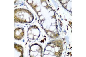 Immunohistochemistry of paraffin-embedded human colon carcinoma using SECISBP2 antibody (ABIN5974073) at dilution of 1/200 (40x lens).