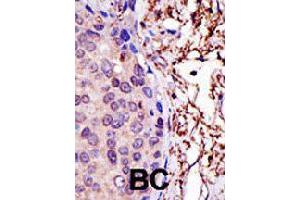 Formalin-fixed and paraffin-embedded human cancer tissue reacted with UBE2L3 polyclonal antibody  , which was peroxidase-conjugated to the secondary antibody, followed by AEC staining. (UBE2L3 antibody  (N-Term))