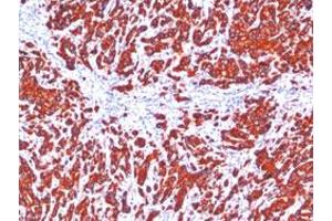 Immunohistochemical staining (Formalin-fixed paraffin-embedded sections) of human breast carcinoma with Pan Cytokeratin monoclonal antibody, clone SPM115 + SPM116 . (Cytokeratin 1 antibody)