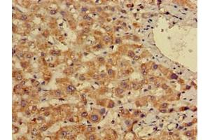 Immunohistochemistry of paraffin-embedded human liver cancer using ABIN7155691 at dilution of 1:100 (EN2 antibody  (AA 1-251))