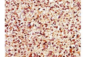 IHC image of ABIN7145017 diluted at 1:400 and staining in paraffin-embedded human glioma performed on a Leica BondTM system. (KCNJ1 antibody  (AA 165-379))