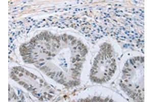 The image on the left is immunohistochemistry of paraffin-embedded Human colon cancer tissue using ABIN7191633(NEUROG2 Antibody) at dilution 1/15, on the right is treated with synthetic peptide. (Neurogenin 2 antibody)