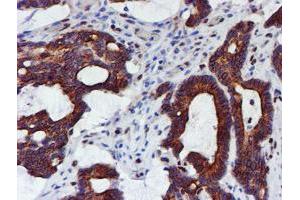 Immunohistochemical staining of paraffin-embedded Adenocarcinoma of Human colon tissue using anti-MEF2C mouse monoclonal antibody. (MEF2C antibody)