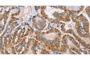 Immunohistochemistry of paraffin-embedded Human thyroid cancer using MSMB Polyclonal Antibody at dilution of 1:30 (MSMB antibody)