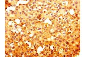 Immunohistochemistry of paraffin-embedded human breast cancer using ABIN7151123 at dilution of 1:100 (RNF13 antibody  (AA 432-685))