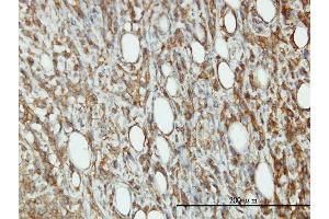 Immunoperoxidase of monoclonal antibody to EIF5 on formalin-fixed paraffin-embedded human malignant lymphoma, diffuse large B tissue. (EIF5 antibody  (AA 1-431))