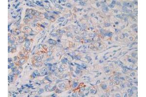 IHC-P analysis of Human Breast Cancer Tissue, with DAB staining. (MME antibody  (AA 382-538))