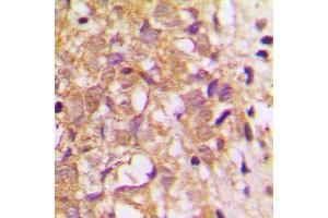 Immunohistochemical analysis of TIMP2 staining in human breast cancer formalin fixed paraffin embedded tissue section. (TIMP2 antibody  (Center))