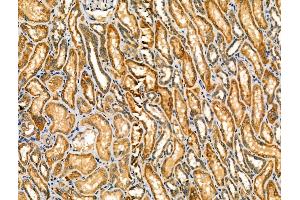ABIN6257628 and ABIN6274171 at 1/100 staining Human kidney cancer and adjacent normal tissues by IHC-P. (PRKCSH antibody  (Internal Region))
