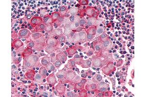 Anti-OR10R2 antibody IHC of human Skin, Melanoma. (OR10R2 antibody  (Extracellular Domain))