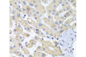 Immunohistochemistry of paraffin-embedded Human liver damage using ABCB8 Polyclonal Antibody at dilution of 1:100 (40x lens). (ABCB8 antibody)