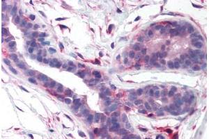 Human Breast (formalin-fixed, paraffin-embedded) stained with PTK2 antibody ABIN213412 at 13 ug/ml followed by biotinylated goat anti-rabbit IgG secondary antibody ABIN481713, alkaline phosphatase-streptavidin and chromogen. (FAK antibody  (Kinase Domain))