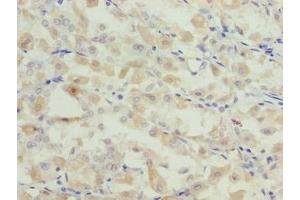 Immunohistochemistry of paraffin-embedded human gastric cancer using ABIN7153839 at dilution of 1:100 (GCSAML antibody  (AA 1-135))