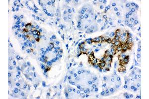 Anti- CYP24A1 Picoband antibody, IHC(P) IHC(P): Human Pancreatic Cancer Tissue (CYP24A1 antibody  (AA 153-514))