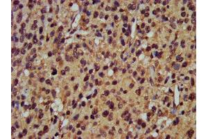 IHC image of ABIN7164940 diluted at 1:400 and staining in paraffin-embedded human glioma performed on a Leica BondTM system. (POMP antibody  (AA 1-141))