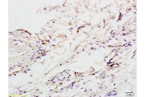 Formalin-fixed and paraffin embedded:human colon carcinoma labeled with Anti-factor VIII(FVIII)(human) Polyclonal Antibody , Unconjugated at 1:200, followed by conjugation to the secondary antibody and DAB staining (Factor VIII antibody  (AA 1451-1550))