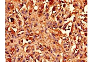 Immunohistochemistry analysis of human melanoma using ABIN7145741 at dilution of 1:100 (BCAT1 antibody  (AA 4-276))