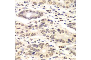 Immunohistochemistry of paraffin-embedded human colon carcinoma using CCNC antibody at dilution of 1:100 (x40 lens). (Cyclin C antibody)