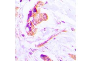 Immunohistochemical analysis of Caspase 3 p17 staining in human lung cancer formalin fixed paraffin embedded tissue section. (Caspase 3 p17 (Center) antibody)