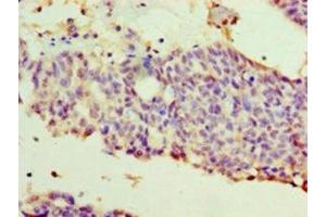 Immunohistochemistry of paraffin-embedded human endometrial cancer using ABIN7175818 at dilution of 1:100 (WT1 antibody  (AA 1-449))