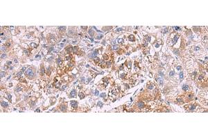 Immunohistochemistry of paraffin-embedded Human liver cancer tissue using GSTCD Polyclonal Antibody at dilution of 1:70(x200) (GSTCD antibody)