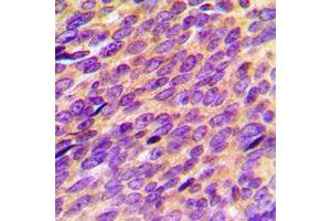 Immunohistochemical analysis of ORAOV1 staining in human breast cancer formalin fixed paraffin embedded tissue section. (ORAOV1 antibody  (Center))