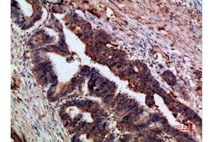 Immunohistochemical analysis of paraffin-embedded human-colon-cancer, antibody was diluted at 1:200 (CTNND1 antibody  (AA 841-890))