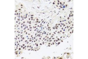 Immunohistochemistry of paraffin-embedded human lung cancer using RPP30 antibody. (RPP30 antibody  (AA 1-268))