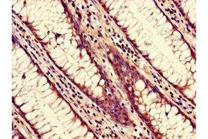 Immunohistochemistry of paraffin-embedded human colon cancer using ABIN7161824 at dilution of 1:100 (NUP85 antibody  (AA 201-500))