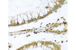 Immunohistochemistry of paraffin-embedded Human colon carcinoma using PMPCB Polyclonal Antibody at dilution of 1:100 (40x lens). (PMPCB antibody)