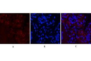 Immunofluorescence analysis of human lung cancer tissue. (Notch1 antibody  (Cleaved-Val1754))