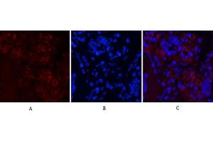 Immunofluorescence analysis of human lung cancer tissue. (Notch1 antibody  (Cleaved-Val1754))