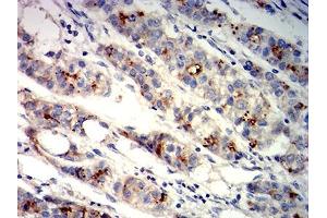 Immunohistochemical analysis of paraffin-embedded liver cancer tissues using GPC3 mouse mAb with DAB staining. (Glypican 3 antibody  (AA 359-554))