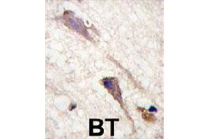 Formalin-fixed and paraffin-embedded human brain tissue reacted with BRAF polyclonal antibody  , which was peroxidase-conjugated to the secondary antibody, followed by DAB staining. (BRAF antibody  (Ser601))