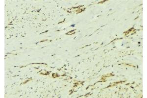 ABIN6276892 at 1/100 staining Human breast cancer tissue by IHC-P. (PTPN2 antibody  (C-Term))