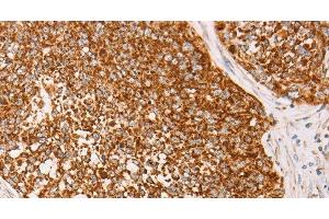 Immunohistochemistry of paraffin-embedded Human cervical cancer using AK2 Polyclonal Antibody at dilution of 1:40 (Adenylate Kinase 2 antibody)