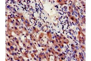 Immunohistochemistry of paraffin-embedded human liver cancer using ABIN7156348 at dilution of 1:100 (INSIG1 antibody  (AA 1-87))