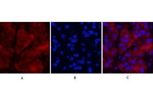 Immunofluorescence analysis of human stomach cancer tissue. (Ubiquitin antibody)