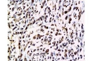Formalin-fixed and paraffin embedded human cervical carcinoma labeled with Anti-NRAS Polyclonal Antibody, Unconjugated  at 1:200 followed by conjugation to the secondary antibody and DAB staining.