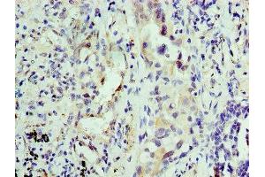 Immunohistochemistry of paraffin-embedded human lung cancer using ABIN7156126 at dilution of 1:100 (KPNA1 antibody  (AA 8-538))