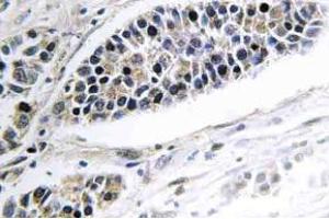 Immunohistochemistry (IHC) analyzes of KDEL Receptor 2 antibody in paraffin-embedded human lung carcinoma tissue.
