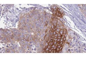 ABIN6279169 at 1/100 staining Human urothelial cancer tissue by IHC-P. (ABCC9 antibody  (C-Term))