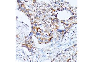 Immunohistochemistry of paraffin-embedded human breast cancer using KCNJ15 antibody (ABIN7269475) at dilution of 1:100 (40x lens). (KCNJ15 antibody  (AA 221-375))