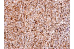 IHC-P Image Immunohistochemical analysis of paraffin-embedded CL1-5 xenograft, using interferon alpha 2, antibody at 1:100 dilution. (IFNA2 antibody  (C-Term))
