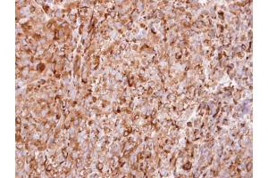 IHC-P Image Immunohistochemical analysis of paraffin-embedded CL1-5 xenograft, using interferon alpha 2, antibody at 1:100 dilution. (IFNA2 antibody  (C-Term))