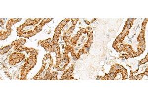 Immunohistochemistry of paraffin-embedded Human thyroid cancer tissue using NUP210 Polyclonal Antibody at dilution of 1:30(x200) (NUP210 antibody)